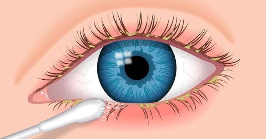 Causes of itchy eyelashes